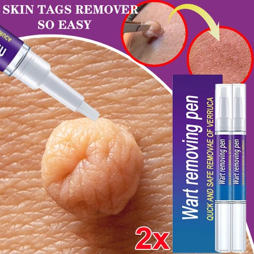 2pack 5ml wart remover - 2pack,